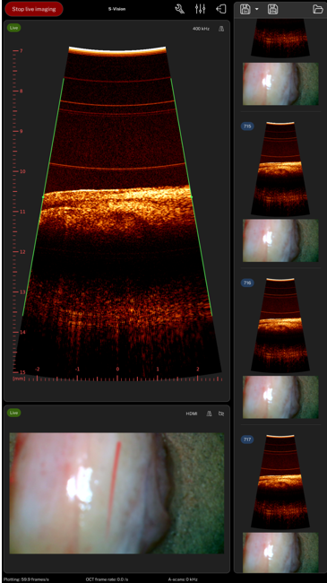 In this image, you can see on the bottom a cystoscopy image of a porcine bladder. On the top you can see the corresponding OCT image (scanning over the red line that is visible in the cystoscopy image). The OCT image shows a cross-section of the bladder wall tissue.